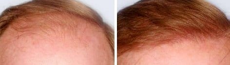 fut hair transplant