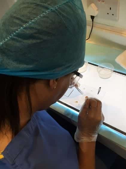 FUE hair transplant holborn clinic