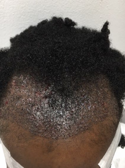 Affro Hair Surgery