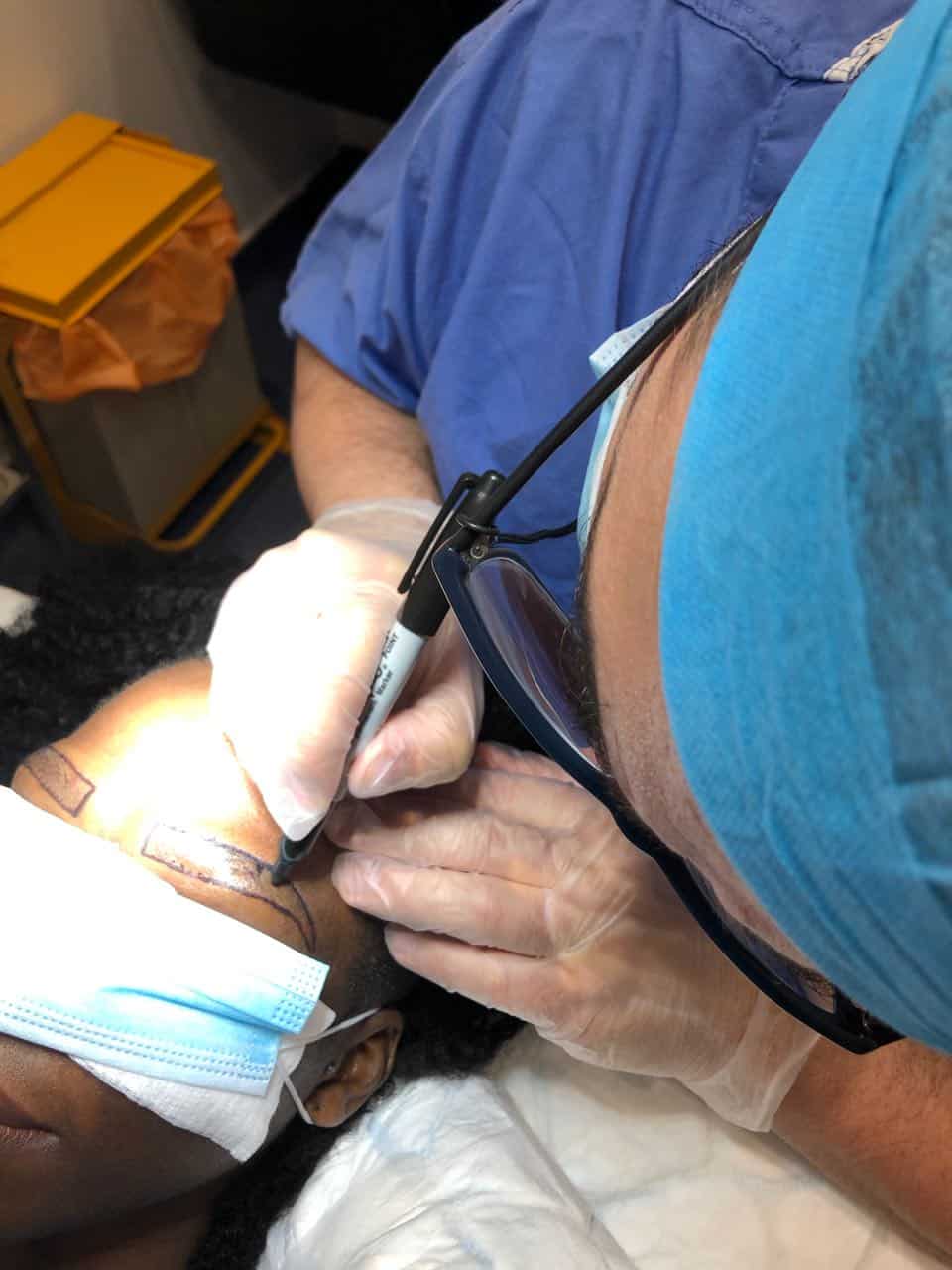afro eyebrow transplant drawing the brows