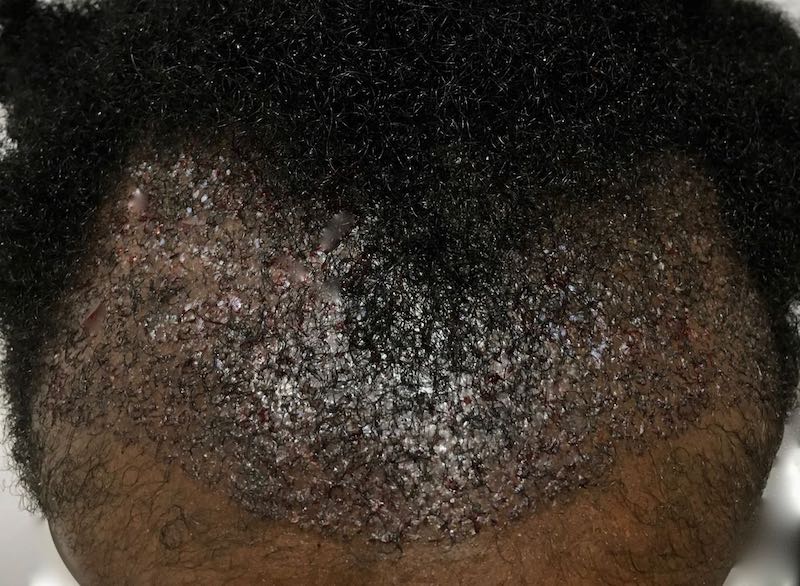 afro transplant before