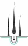 Hair transplantation poster