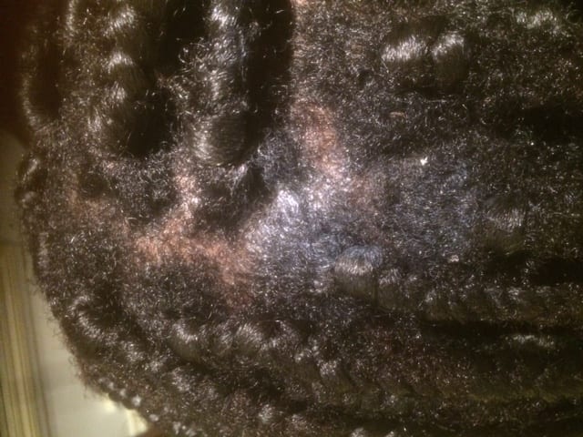 scaly scalp afro