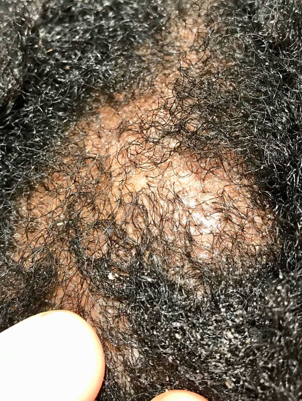 afro scalp cleansing lichen planus
