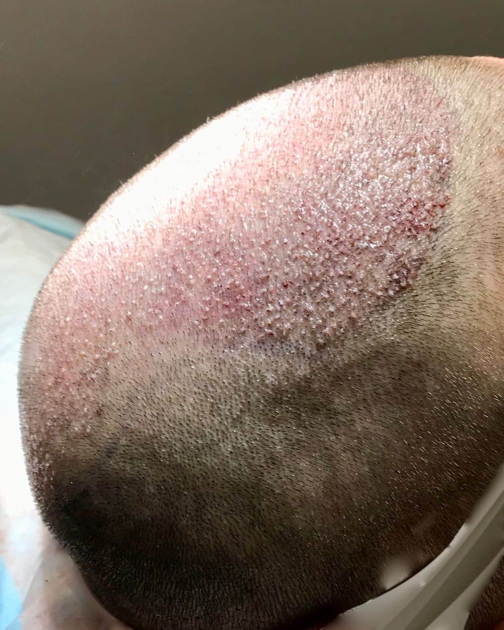 fue fut transplant