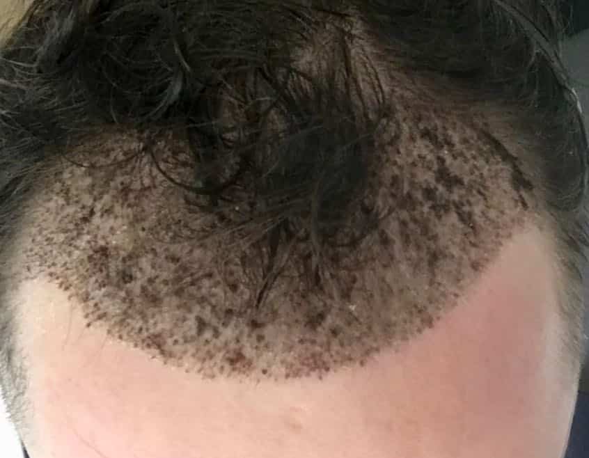 fue fut transplant during