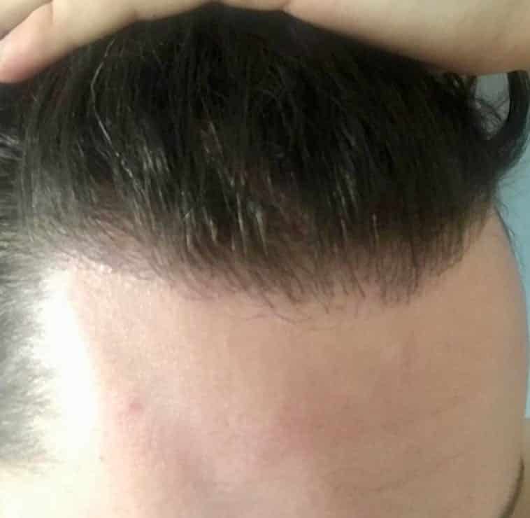 fue fut transplant after