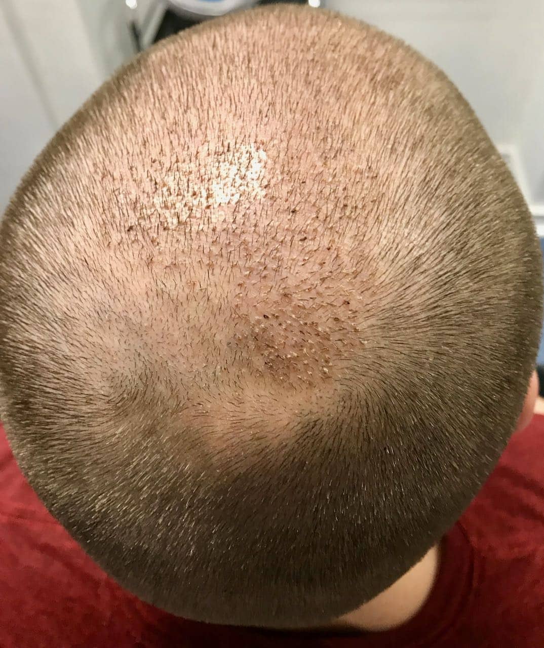 fue fut transplant