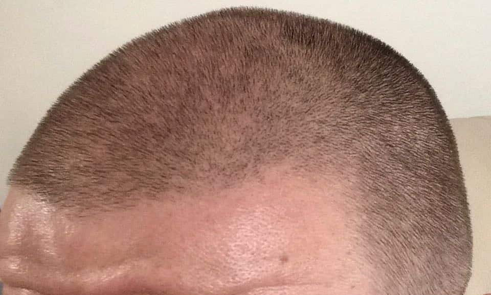 fue fut transplant