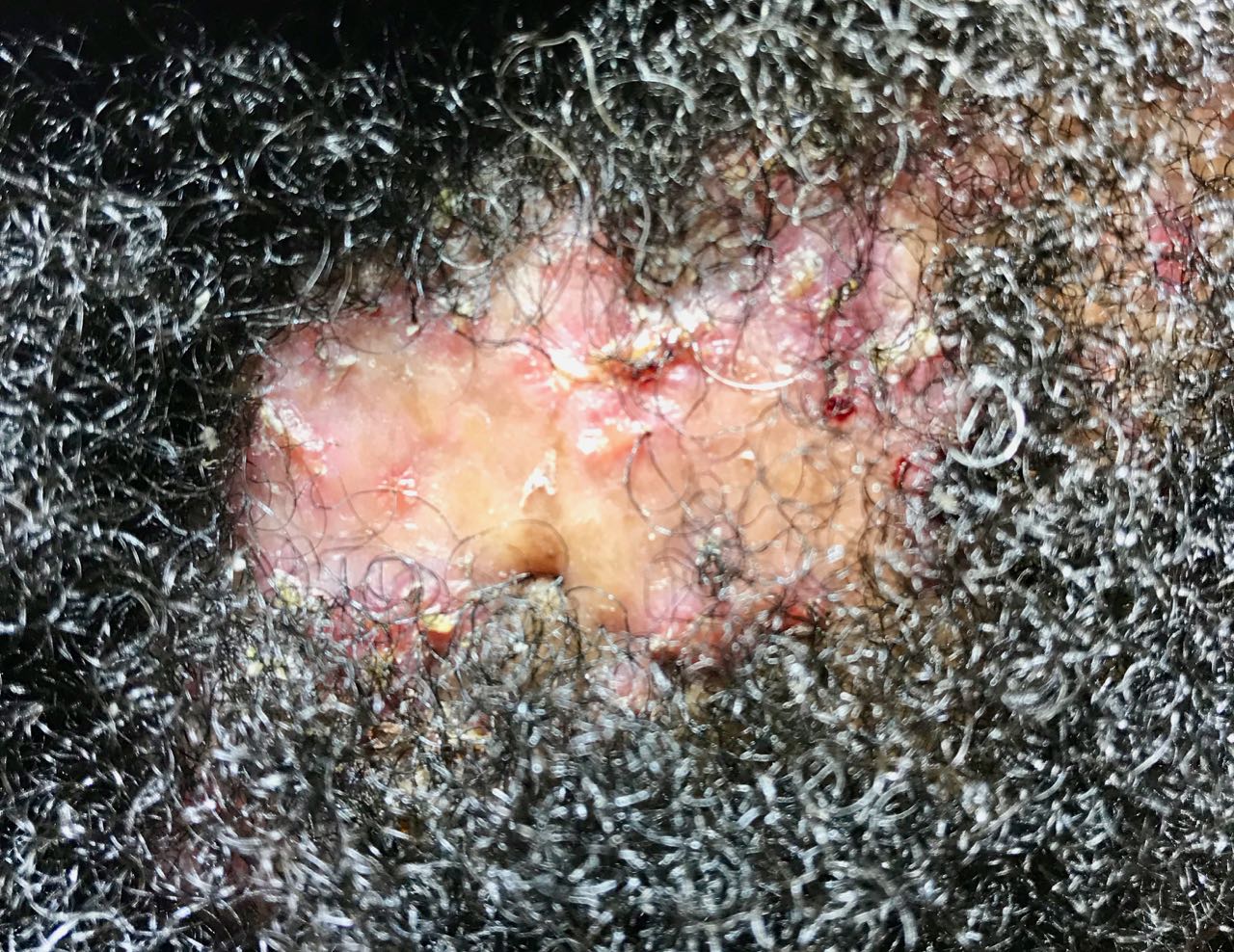 scarring alopecia