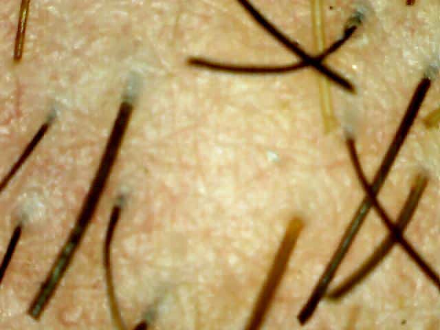 women’s hair loss