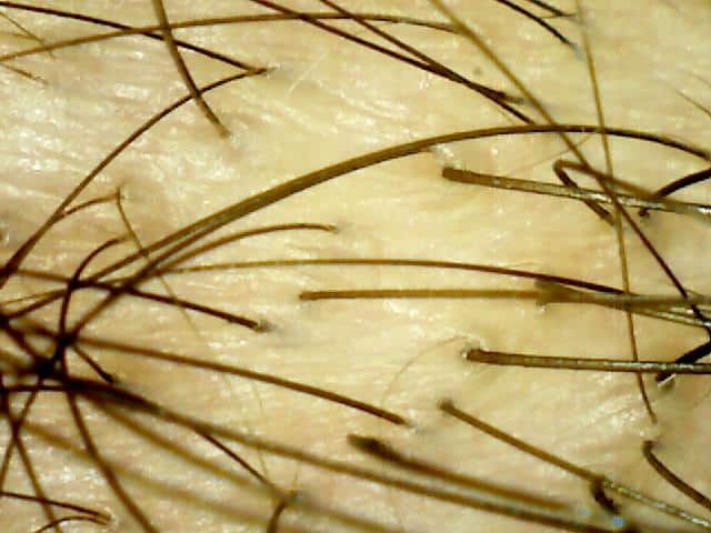 women’s hair loss