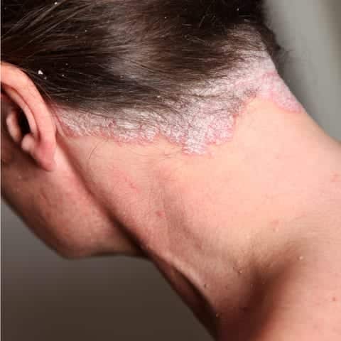 scalp psoriasis