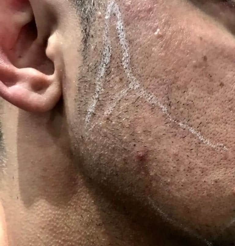 Beard Transplant Beard Surgery Holborn Hair Scalp Clinic UK