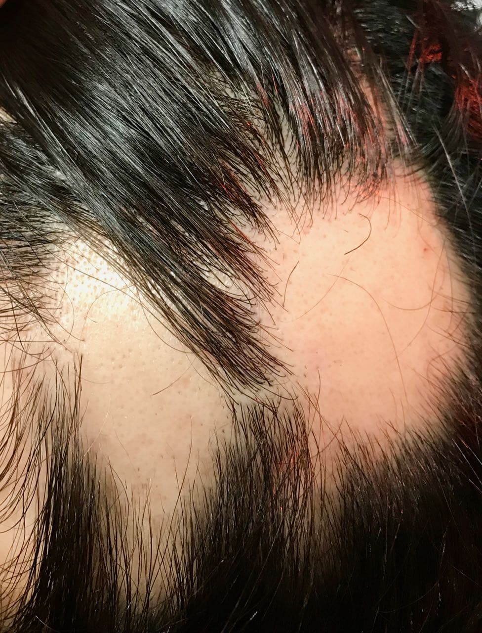 Alopecia Areata, bald spots, alopecia totals, alopecia universals