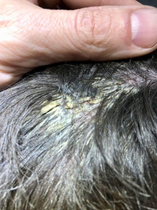 itchy scalp dry scalp flaky scalp crusty scalp skin cancer