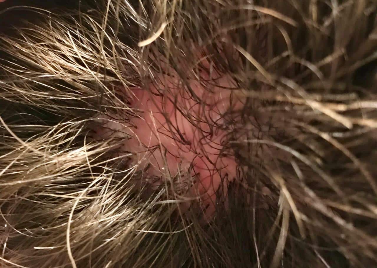 scarring alopecia