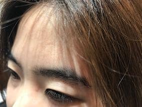 women's hair surgery eyebrows