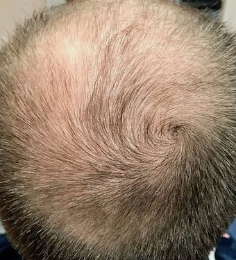 hair loss male pattern baldness