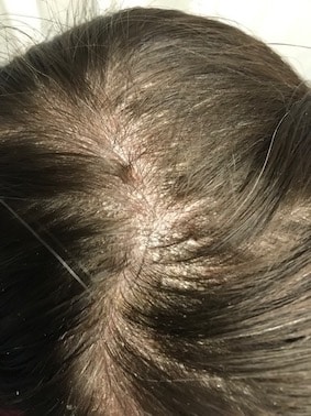 scalp disease