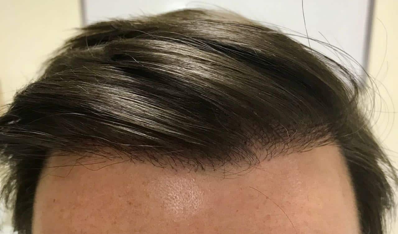 micropigmentation after
