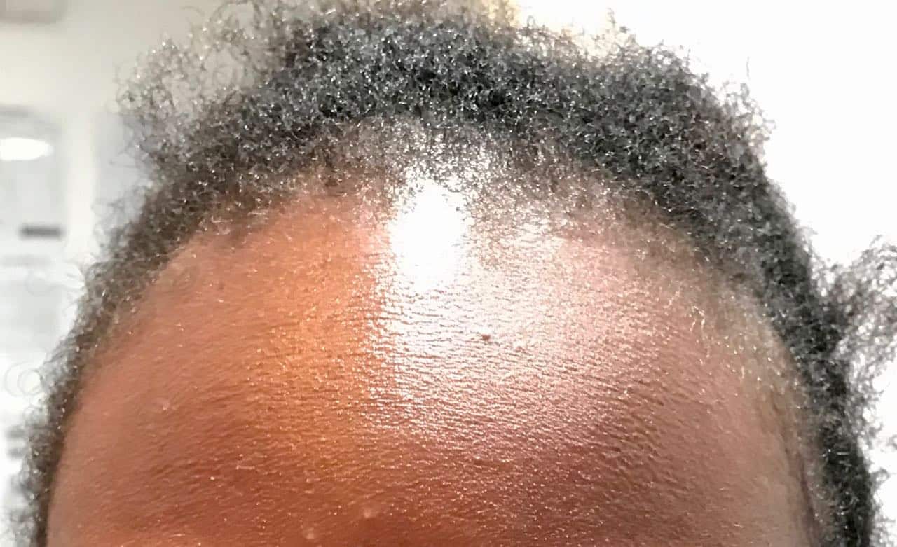 Afro Hair surgery