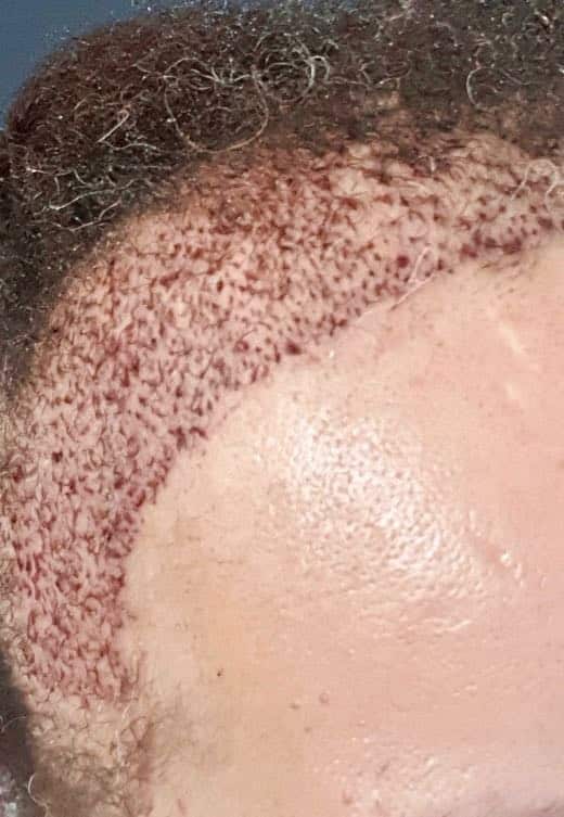 FAQ Afro Hair transplant