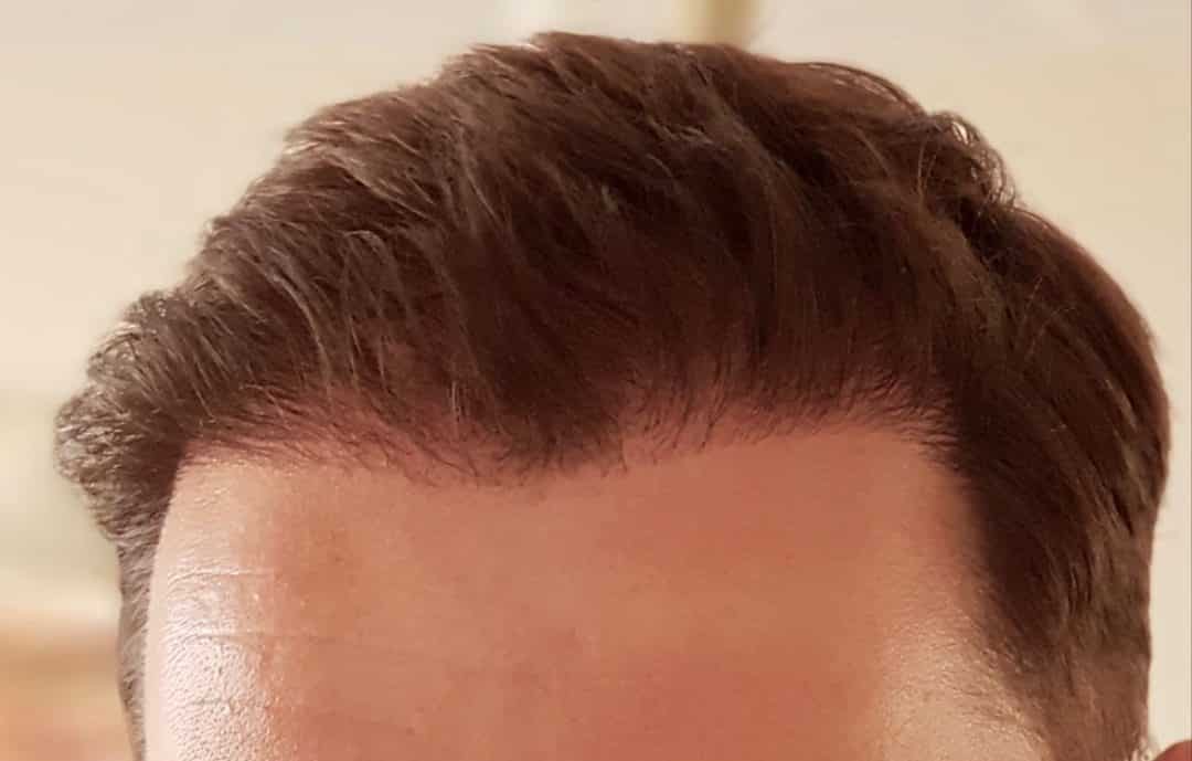 FUE Hair Transplant London Holborn Hair Scalp Clinic