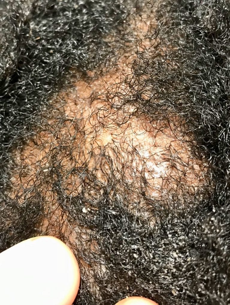 afro-scalp-cleansing-remove-the-itchy-dry-flaky-scalp