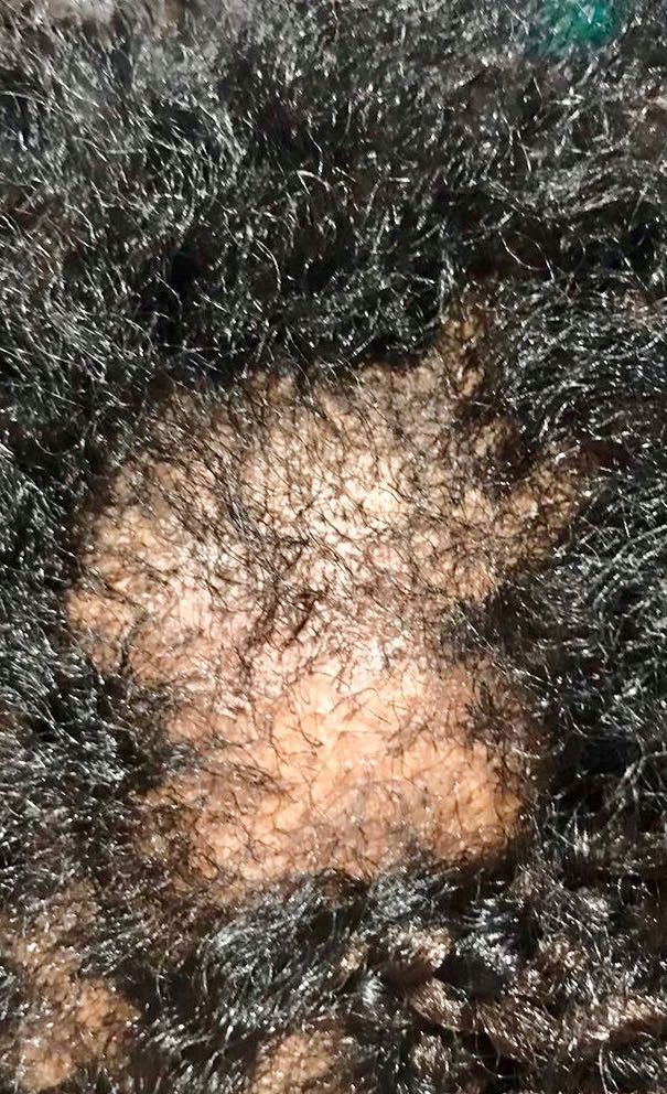 afro scalp