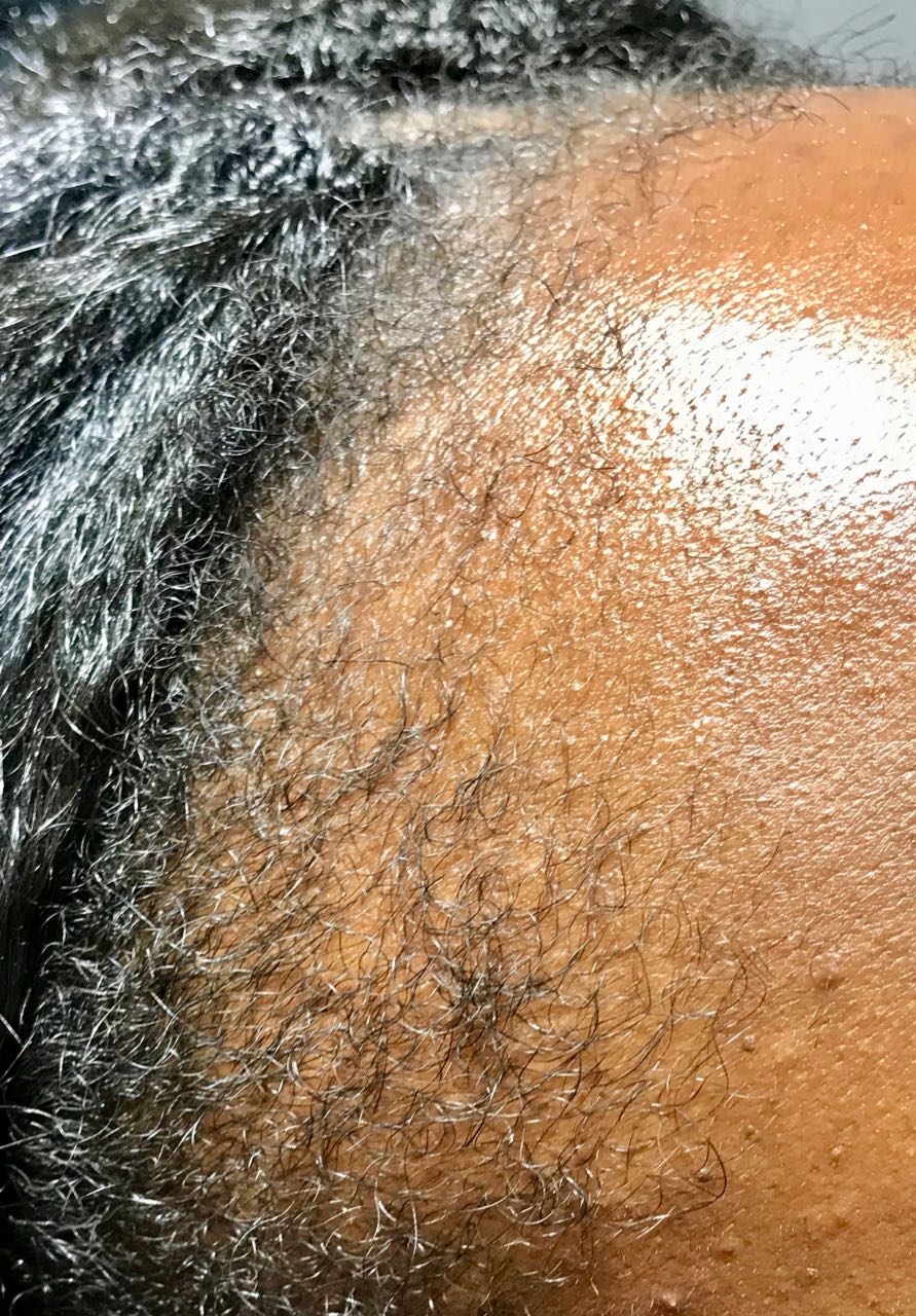 afro scalp