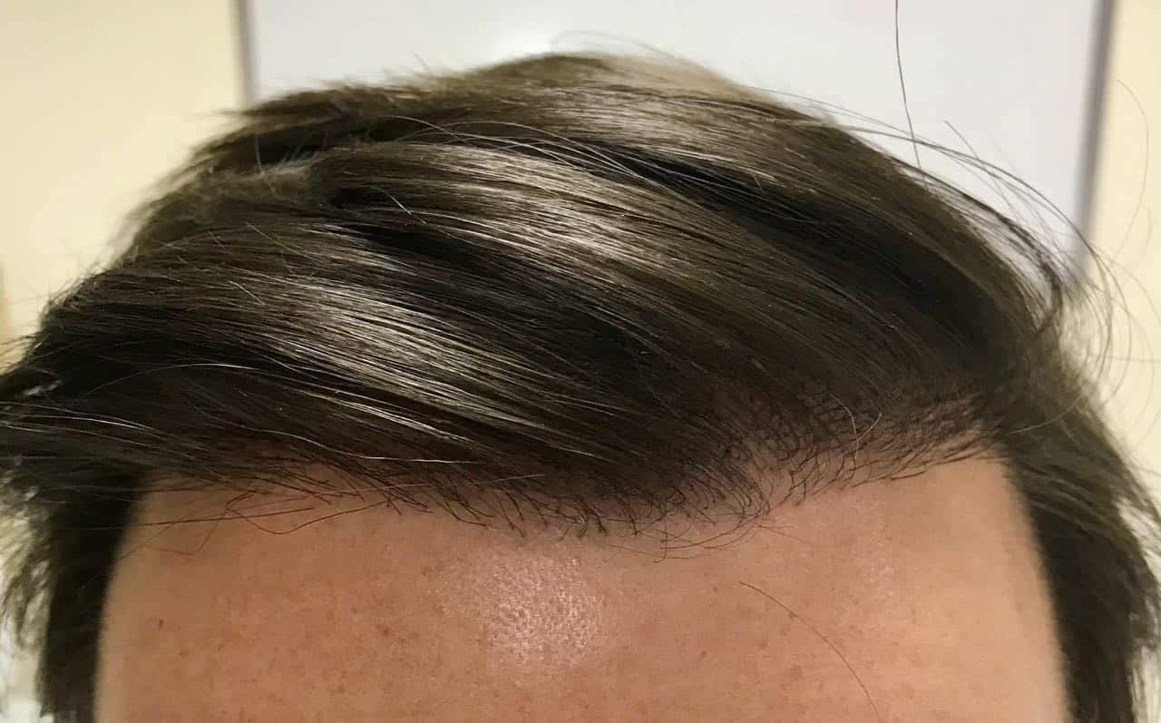 fue Hair Transplant