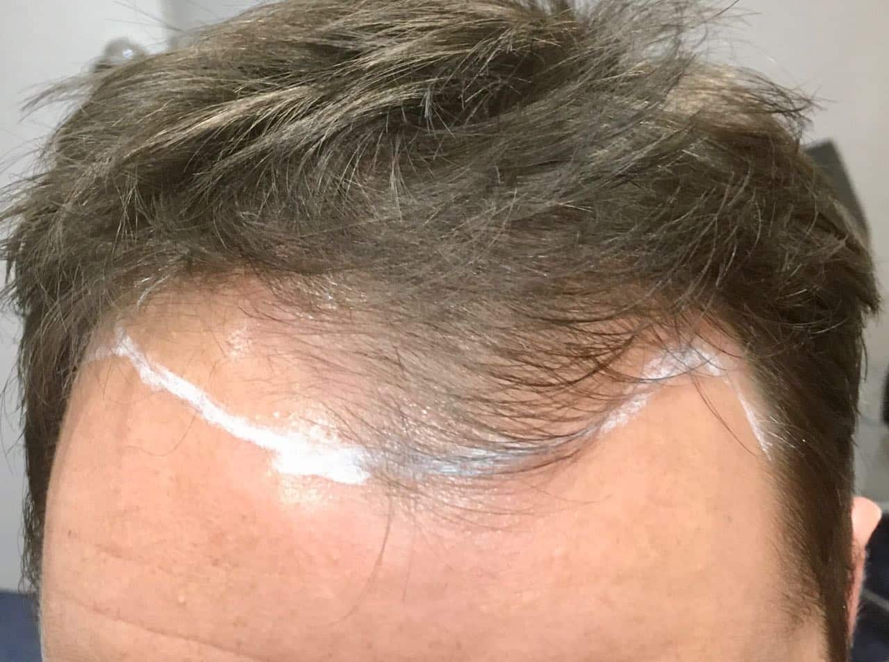 fue Hair Transplant