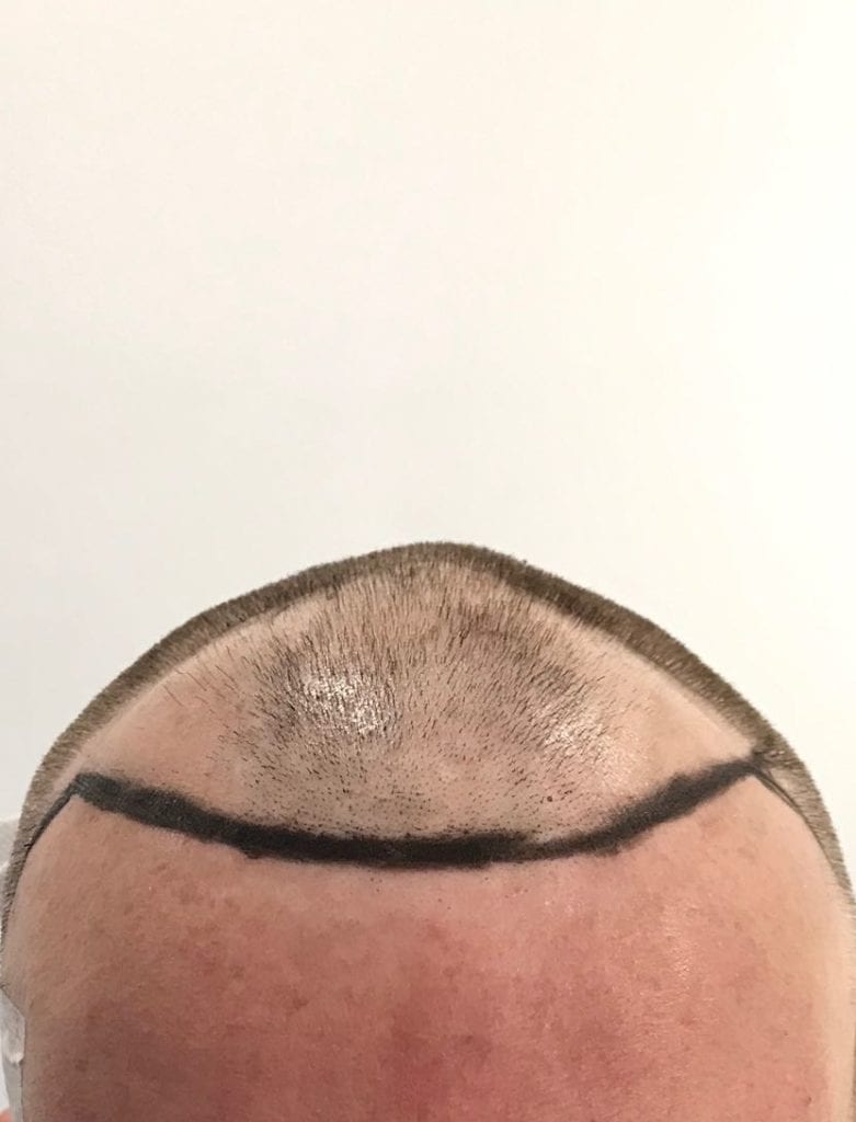 FUE Hair Transplant London Holborn Hair Scalp Clinic