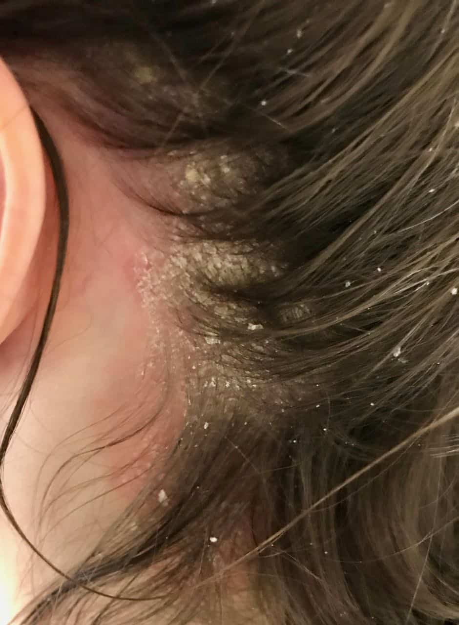 psoriasis flaky scalp)