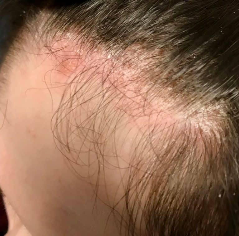 Scalp Psoriasis Itchy Scalp Dry Scalp Scalp Crusting scalp-psoriasis-itchy-scalp-dry-scalp-scalp-crusting
