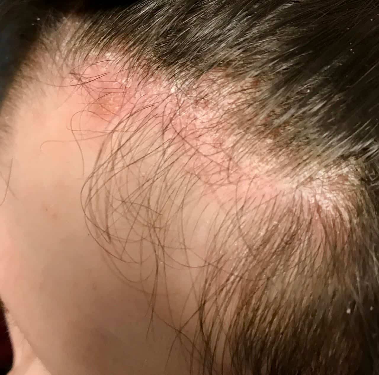 children's hair loss