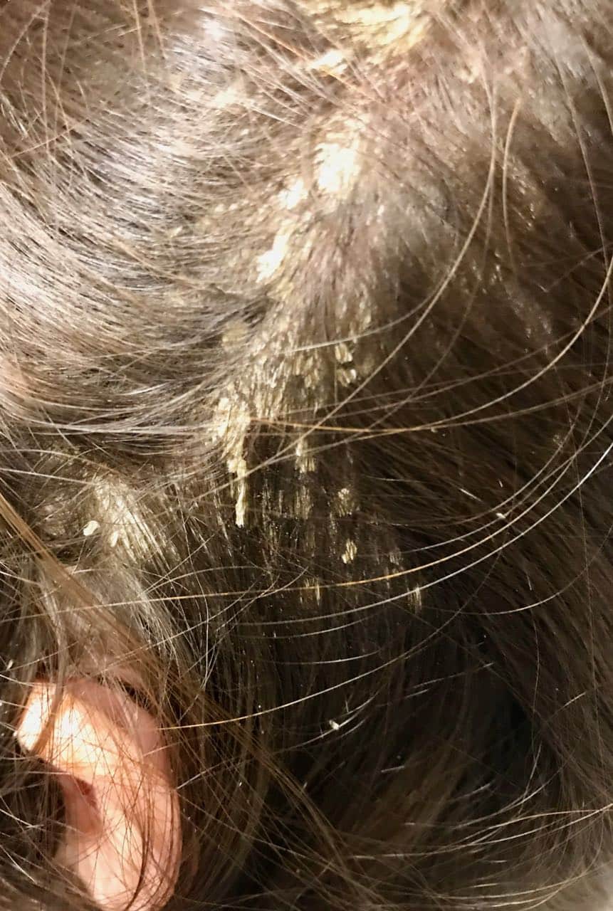 psoriasis removal scalp