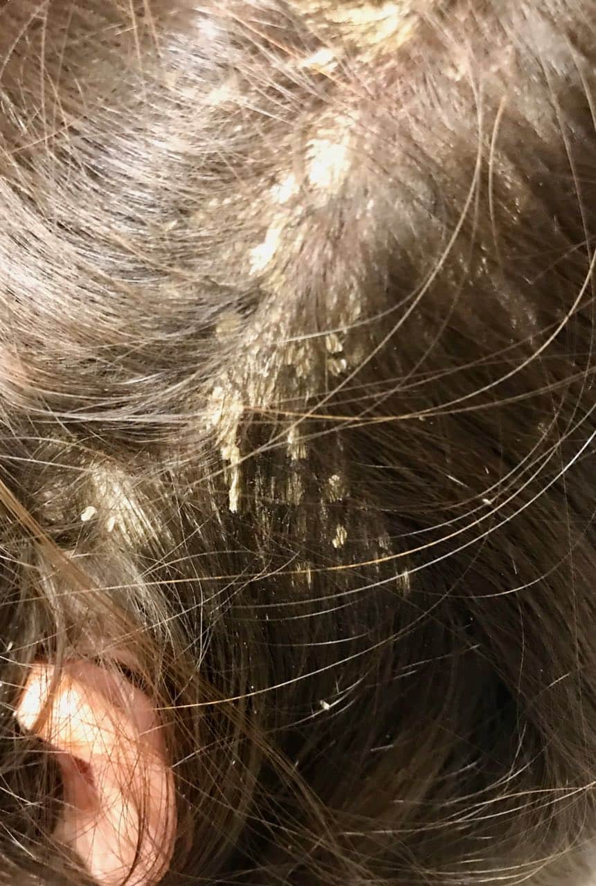 Plaque psoriasis scalp