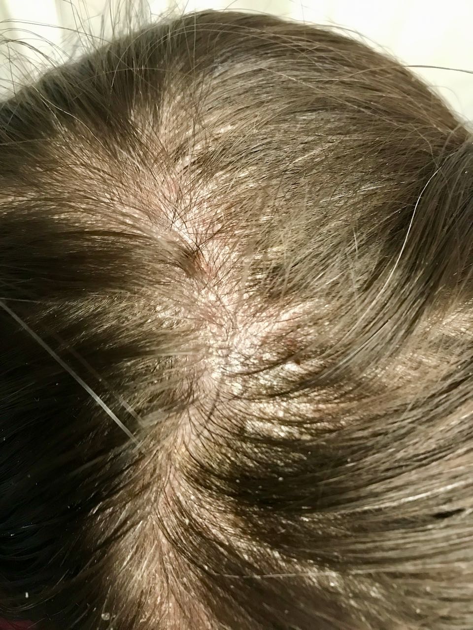 psoriasis flaky scalp