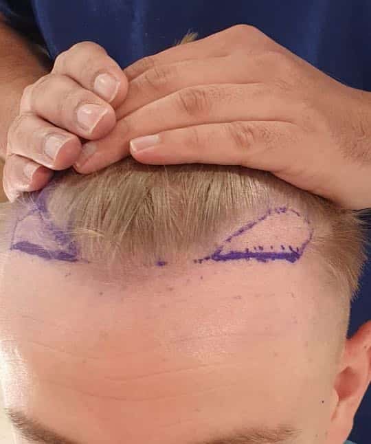 fue hair transplant